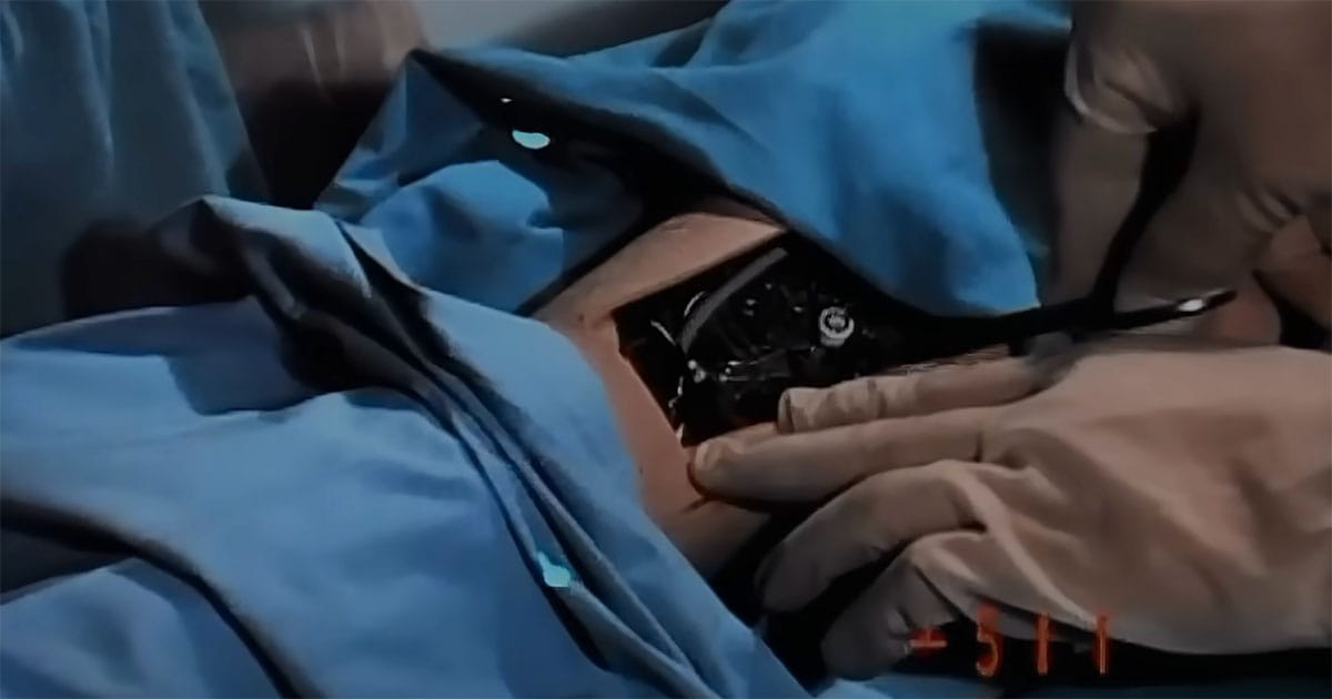 Surgical scene showing bionic components being installed in Steve Austin in The Six Million Dollar Man